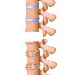 Kaklo osteochondrozės rampų stadijos