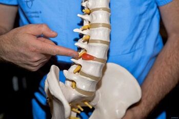 Kodėl nugara skauda apatinėje nugaros dalyje ir ką daryti