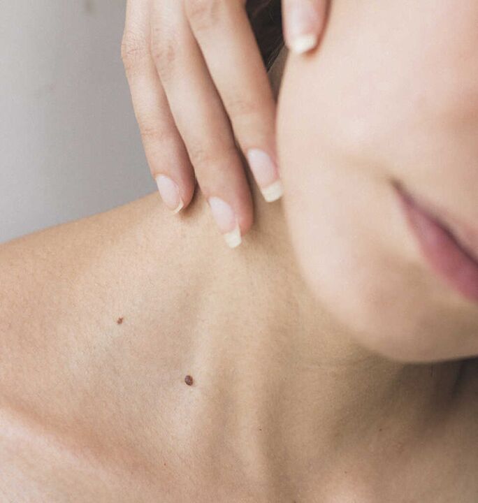 Kaklo standumas yra vienas iš pradinės kaklo stuburo osteochondrozės stadijos simptomų.