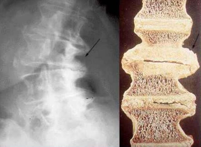slankstelių pažeidimas sergant krūtinės ląstos osteochondroze