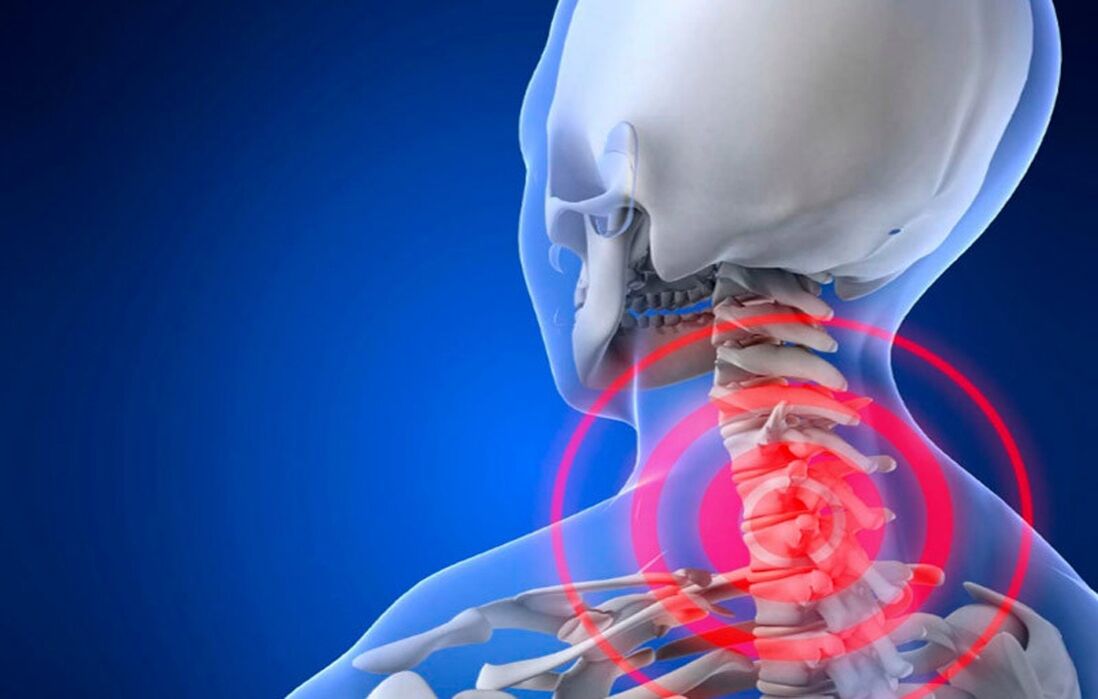 kaklo stuburo osteochondrozė